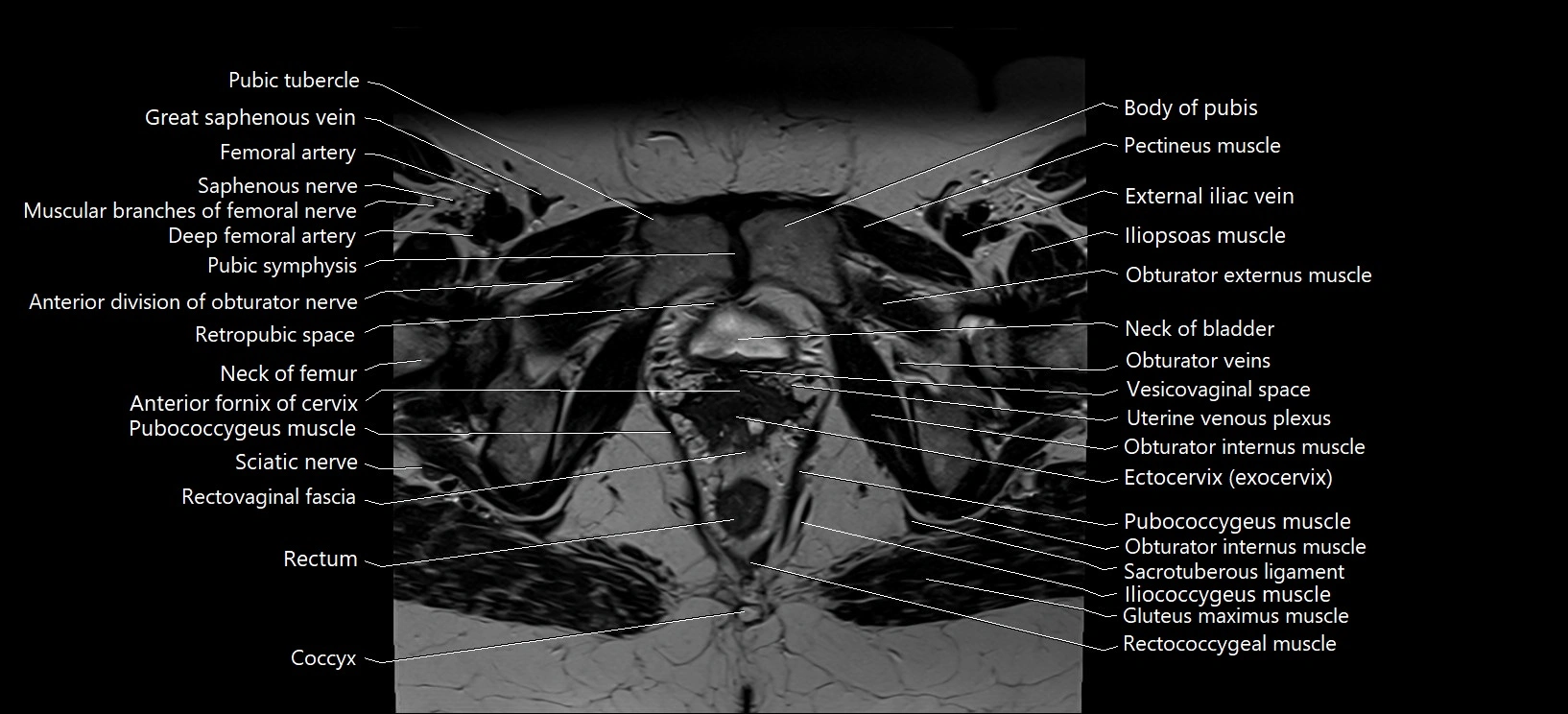 Axial cross sectional anatomy of female pelvis (MRI 3T) image 33.webp